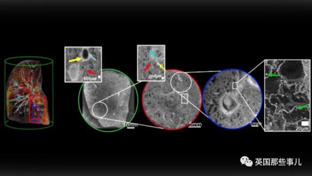 人类最强的X光,告诉我们新冠患者的肺长这样！